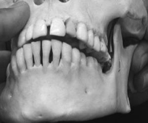 Imagen de movimiento de lateralidad mandibular derecho comprometido por la falta de espacio en el lado izquierdo, en donde se puede observar cómo se ve limitada la amplitud del movimiento de la articulación al golpear la cara interna de la rama mandibular izquierda contra el molar superior izquierdo extruido, generando CAT.