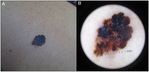 Imágenes enviadas a través del sistema de TD. A) Clínica macro: se observa lesión pigmentada asimétrica de bordes irregulares y policrómica. B) Dermatoscopia: se observa lesión pigmentada con asimetría en estructuras y color, retículo atípico, proyecciones y áreas de regresión, datos sugestivos de malignidad compatible con melanoma maligno.