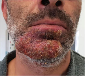 Placa inflamatoria con costras melicéricas.