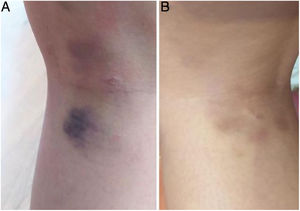 A) Paciente correspondiente al caso 1 con múltiples hematomas en hueco poplíteo, el mayor de 20×25mm. Imagen capturada al 4.° día de evolución. B) Paciente correspondiente al caso 2 con múltiples hematomas, también en hueco poplíteo, el mayor de 15×7mm. Imagen capturada al 8.° día de evolución.