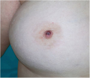 Imagen clínica de la lesión. Mácula pigmentada heterogénea de 6mm de diámetro en la mitad superior del pezón de la mama derecha.