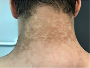 Presentación clínica de la papilomatosis reticulada y confluente de Gougerot y Carteaud. Pápulas queratósicas parduzcas, asociadas a pseudoestrías lineales, en la región cervical posterior, con tendencia a confluir formando placas con aspecto reticulado en la periferia.