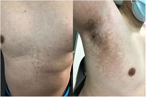 Presentación clínica de la papilomatosis reticulada y confluente de Gougerot y Carteaud. Pápulas queratósicas parduzcas, asociadas a pseudoestrías lineales, en el tórax anterior y ambas axilas, con tendencia a confluir formando placas con aspecto reticulado en la periferia.