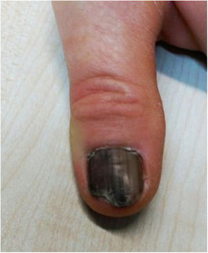Lesión ungueal del caso clínico.