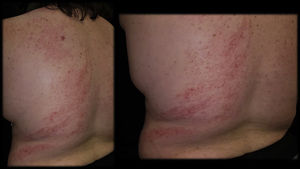 Erupción eritematosa papular no folicular distribuida de forma lineal y segmentaria localizada en hemitronco posterior.