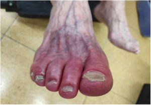 Pie derecho con eritromelia.
