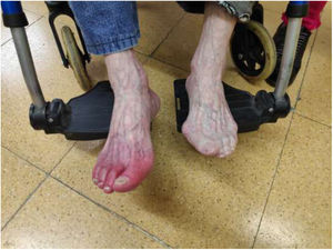 Pie derecho con eritromelia distal, pie izquierdo con color normal.