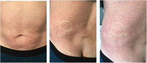 Coloración eritemato-violácea y dermografismo blanco en el abdomen del paciente COVID-19. Se observa la marca del borde del fonendoscopio y los dedos del médico. La calidad de la fotografía no es óptima debido a las dificultades para realizarla en el contexto del aislamiento por gotas y por contacto del paciente. El color de la figura solo puede apreciarse en la versión electrónica del artículo.