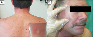 A) Imagen clínica del paciente 1, que muestra endurecimiento cutáneo en hombros y región cervical posterior, donde se asocia un leve eritema. Detalle del eritema que blanquea a la digitopresión en la imagen del margen inferior derecho. B) Imagen clínica del paciente 3 que muestra una piel facial endurecida, tensa, con dificultad para ser pellizcada, levemente eritematosa y brillante.