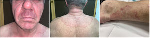 Aspecto clínico de las lesiones cutáneas. A. Placa eritematosa en la región facial con pápulas y pústulas foliculares en el labio superior. B. Demarcación neta y sobreelevada de la lesión a nivel dorsal. C. Placas anulares policíclicas en la cara posteromedial de la pierna derecha.