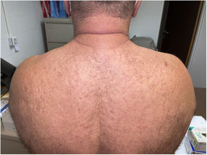 Evaluación clínica tras 3 semanas de tratamiento tópico con terbinafina. Desaparición de las lesiones a nivel dorsal, con regresión completa del borde de avance micótico.