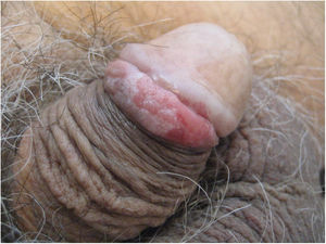 Papulosis bowenoide (elaboración propia).