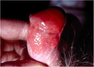 Eritroplasia de Queyrat.