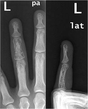 Radiografía simple posteroanterior (izquierda) y lateral (derecha) focalizada en el cuarto dedo de la mano izquierda. Se aprecia una desestructuración de la cortical de la falange del dedo medio a expensas de un patrón lítico de aspecto microcístico, similar a un patrón en panal con respeto de los espacios articulares.
