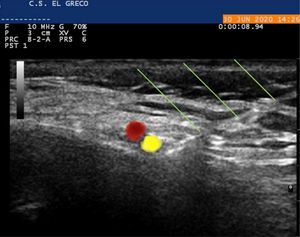 Infiltración bajo guía ecográfica con colocación de la punta de la aguja en situación perineural. Se identifica con efecto Doppler la arteria occipital (en rojo). Adyacente y medial a esta, ilustrado en amarillo, el nervio occipital. Flechas verdes señalan la aguja.