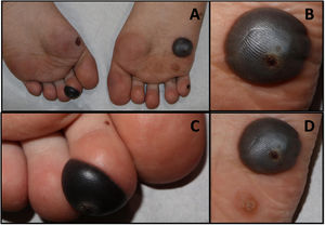 Clinical image: A. Hemorrhagic blisters located on both plantar areas. Two tense blisters B. Detail of tense bullae in right sole; note the hyperkeratotic lesion corresponding to the viral wart C. Detail of the lesion on the plantar aspect of the second left toe with a viral wart on top. D. Tense hemorrhagic bullae located on the upper part of one hyperkeratotic papule with black dots compatible with an untreated wart.