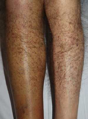 Púrpura folicular con pelos «en sacacorchos», simétrica, en miembros inferiores.