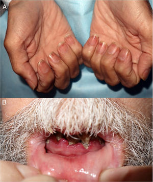 A. Hemorragias en astilla en las uñas de las manos. B. Gingivitis hemorrágica, hipertrofia gingival y pérdida dentaria.