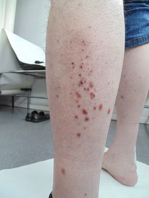 Lesiones papulosas purpúricas en extremidades inferiores.