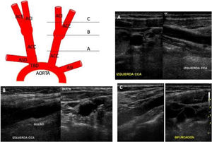 Anatomía de los troncos supraaórticos y visión ecográfica de las arterias carótidas en diferentes trayectos en corte longitudinal y transversal. A)A nivel de la arteria carótida común. B)A nivel del bulbo carotídeo. C)A nivel de la bifurcación de la arteria carótida común en carótida interna y externa. ACC: arteria carótida común; ACE: arteria carótida externa; ACI: arteria carótida interna; ASD: arteria subclavia derecha; ASI: arteria subclavia izquierda; TBD: tronco braquiocefálico derecho.