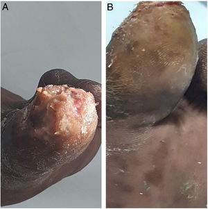 Gran úlcera infectada: deformaciones cicatriciales y pérdida de la uña. Lesiones pustulosas confluyentes. Residuos de parásito y huevos diseminados. En la piel circundante hiperqueratosis y descamación.A. Lesiones maculopapulares hipercrómicas con zona central puntiforme negruzca. B. Lesiones con aspecto de verrugas plantares.