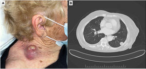 A) Masa cervical de 5cm, fluctuante, localizada en el espacio supraclavicular derecho. B) Tomografía computarizada en la que se aprecia lesión nodular en el sexto segmento pulmonar derecho.
