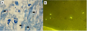 A) Tinción de Ziehl-Neelsen del pus obtenido tras la punción, en la que se observan bacilos ácido-alcohol resistentes (flechas). B) Fluorescencia positiva para Mycobacterium tuberculosis tras la tinción de la muestra con auramina-rodamina.
