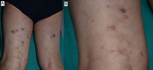 a y b) Pápulas blanquecinas agrupadas sobre una base eritematosa en parte posterior de extremidades inferiores.
