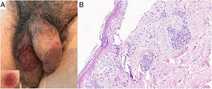 A)En la región genital se aprecian dos placas circulares de 6cm (lesión escrotal) y 4cm (lesión peneana) de diámetro máximo, eritematovioláceas y con zona ampollosa central de una semana de evolución. En el recuadro inferior izquierdo, detalle de una lesión de aparición reciente en cuyo centro se visualiza una ampolla de contenido seroso y tensa, con zona periférica eritematosa. B)Hematoxilina-eosina (×20): ampolla subepidérmica con necrosis de queratinocitos epidérmicos e infiltrado inflamatorio dérmico perivascular superficial de predominio linfocitario.