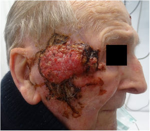 Se aprecia una lesión de 6x6 cm ocupando la totalidad del arco cigomático derecho, friable, ulcerosa y con tendencia al sangrado. Esta lesión era compatible con un carcinoma epidermoide cutáneo. La evolución del tumor había sido rápida los meses previos a la consulta.