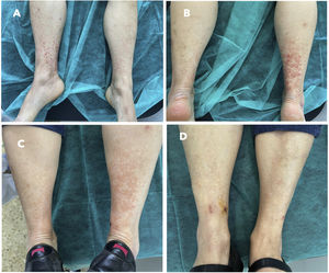 A-B) Piernas con lesiones purpúricas tras la administración de la vacuna. C-D) Piernas con lesiones residuales tras la administración de antiinflamatorios no esteroideos.