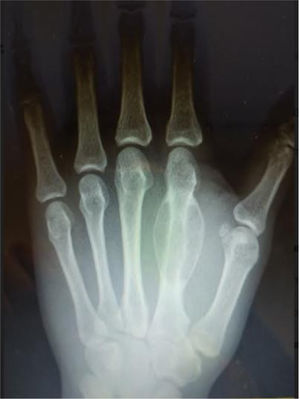 Imagen de RX simple: lesión lítica expansiva –de origen intramedular y que se extiende excéntricamente– en la región dorsal de la diáfisis del 2.° metacarpiano, rodeada de un arco arbotante de reacción perióstica en sus extremos proximal y distal. Según el radiólogo, en el diagnóstico diferencial se incluirían tres entidades: quiste óseo aneurismático, fibroma condromixoide y tumor de células gigantes, recomendando ampliar el estudio mediante resonancia magnética (RM).