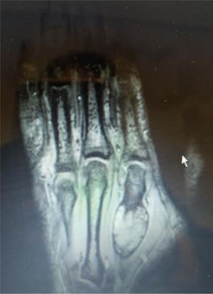 Imagen de RM: tumoración mixta, intramedular y paracortical, a nivel dorsal de la diáfisis del 2.° metacarpiano con signos de afectación de la medular ósea, adelgazamiento-disrupción de la cortical dorsal y componente extraóseo (el proximal sólido y el más distal de aspecto aneurismático). Presenta unas medidas de 32x20x13mm con eje paralelo longitudinal a la diáfisis del metacarpiano, con señal de RM heterogénea. Existe edema perilesional pero con aparente preservación del tendón extensor vecino.