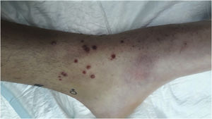 Lesiones maculopapulosas eritemato-violáceas en superficie dorsal del tobillo izquierdo, compatibles con queratodermia blenorrágica.