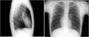 Imagen de radiografía de tórax del paciente.
