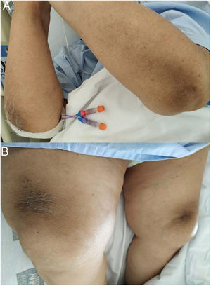Hyperkeratotic and symmetric areas on the back side of her arms (A) and the lower portion of both thighs (B).