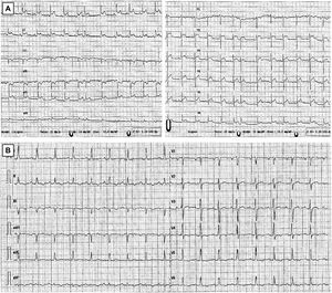 Electrocardiogramas al ingreso (A) y a los 3 meses de tratamiento (B). Nótese la elevación cóncava y difusa del segmento ST en el ECG inicial y la normalización del mismo en el ECG de control, quedando una alteración inespecífica en la repolarización en cara inferior y precordiales izquierdas.