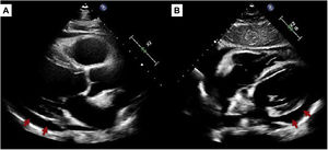 Ecocardiograma al ingreso. Destaca la presencia de pericardio hiperrefringente y derrame pericárdico moderado de predominio en saco posterior (flechas).