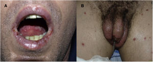 A) Lesiones erosivas localizadas en mucosa lingual y labial. B) Erosión y costra hemorrágica en glande, máculas dianiformes en extremidades inferiores.