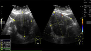 Ecografía abdominal que muestra un útero aumentado de tamaño, con diámetro mayor de 10,09cm en el corte transversal y de 10,88cm en el corte longitudinal, con vascularización de predominio periférico en el estudio Doppler color.