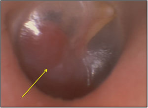 (Flecha) Masa retrotimpánica de color rojizo, situada en los cuadrantes posteriores del oído derecho.