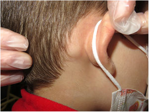 Adenopatías retroauriculares de 1,5cm de diámetro claramente visibles y dolorosas a la palpación.