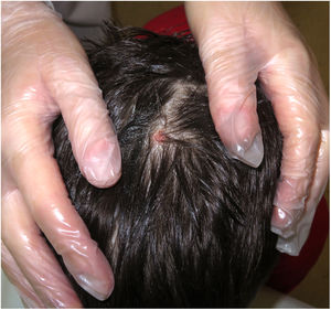 Aspecto clínico del vértex del paciente tras extraer la escara necrótica, mostrando una pequeña placa erosionada alopécica.