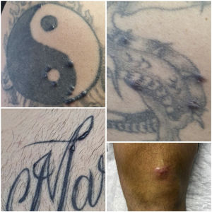 Iconografía de las lesiones del paciente. Se observan los granulomas más significativos del paciente; 3 de ellos sobre tatuajes y uno sobre una cicatriz previa.
