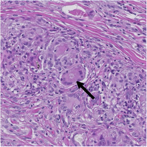 Imagen histológica. Imagen microscópica de una de las lesiones biopsiadas. La flecha negra señala un cuerpo de asteroide, un hallazgo microscópico de la sarcoidosis cutánea.
