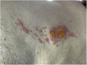 Ampollas tensas lineales sobre una base eritematosa en el contexto de fitofotodermatitis.