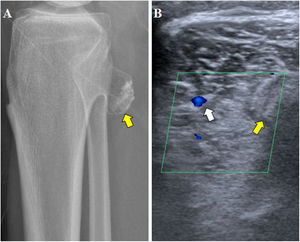 A)Radiografía simple de rodilla derecha, proyección lateral. Osteocondroma dependiente del margen posterolateral de la metáfisis tibial (flecha amarilla). B)Ecografía de hueco poplíteo derecho. Calibre disminuido de la arteria poplítea (flecha blanca) en su tramo adyacente al osteocondroma (flecha amarilla).