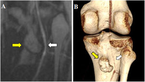 A)Imagen de resonancia magnética de la rodilla derecha en secuencia coronal posterior, mostrando la impronta del osteocondroma (flecha amarilla) sobre la arteria poplítea (flecha blanca). B)Angiografía por TC, reconstrucción volumétrica 3D, vista posterior. Arteria poplítea derecha prácticamente imperceptible (flecha blanca) en contacto con el osteocondroma (flecha amarilla).