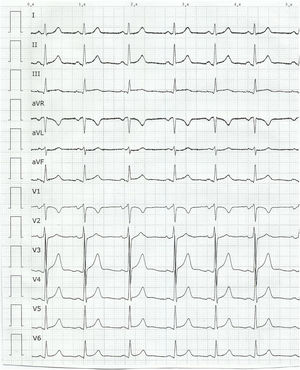 Electrograma inicial: ritmo sinusal a 75 lpm; QRS estrecho, discreta elevación de ST <1 mm en cara inferior y V5-V6.