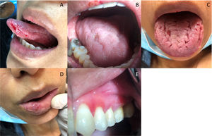 Manifestaciones orales en la primera cita. A-C: lesiones linguales en diferentes estados de evolución. D: labio. E: encía insertada (gingivitis descamativa).